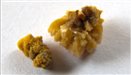 Kidney stones