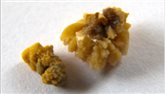 Kidney stones