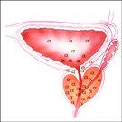 Medical Treatment of Lower Urinary Tract Symptoms (LUTS)