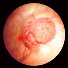 05 Developments in the Management of Bladder Cancer