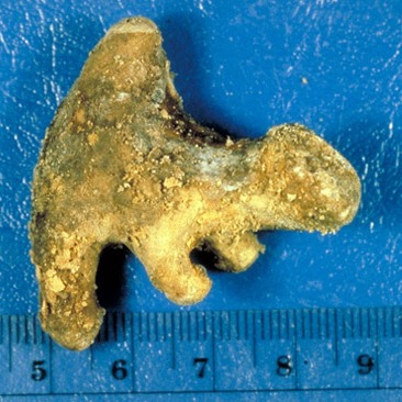 Renal calculi