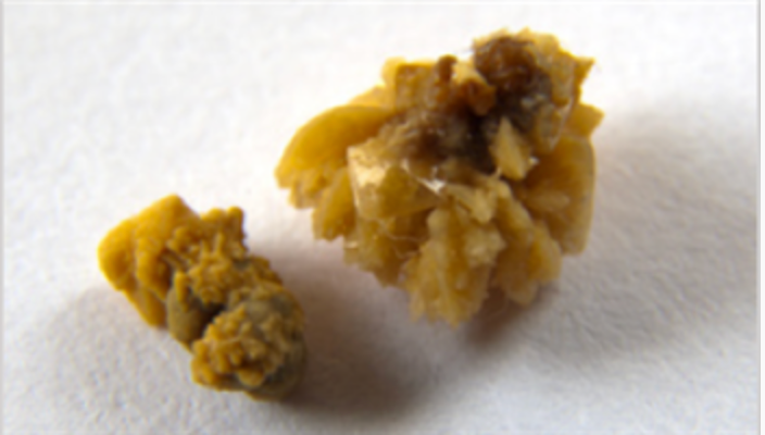 Struvite renal stone