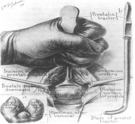 First Prostatectomy