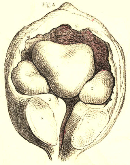 Bladder Stones