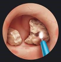 picture of kidney stone on ct scan