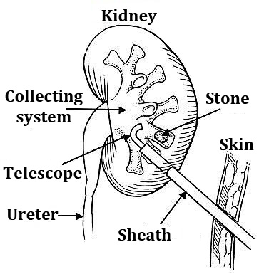 pictures of kidney stone pain location