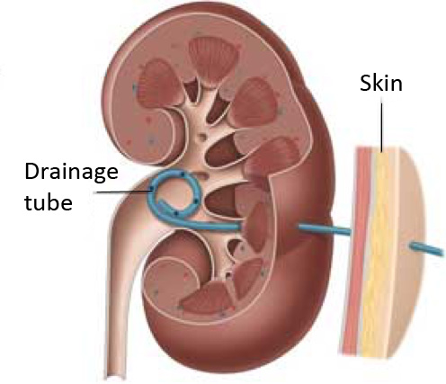 images of kidney stones on ct scan