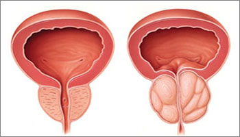 Benign Prostatic Hyperplasia (prostate adenoma) - Cancer with benign prostatic hyperplasia