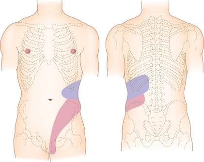 pics of kidney stones in urine