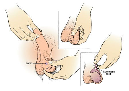 modstå announcer Børnehave Testicular lump | The British Association of Urological Surgeons Limited