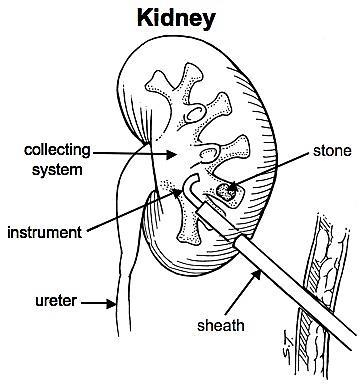 Percutaneous access