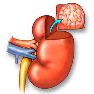 Partial nephrectomy