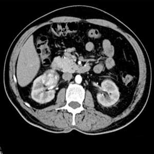 T Stage kidney cancer image
