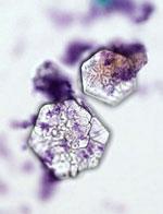 Cystinuria UK