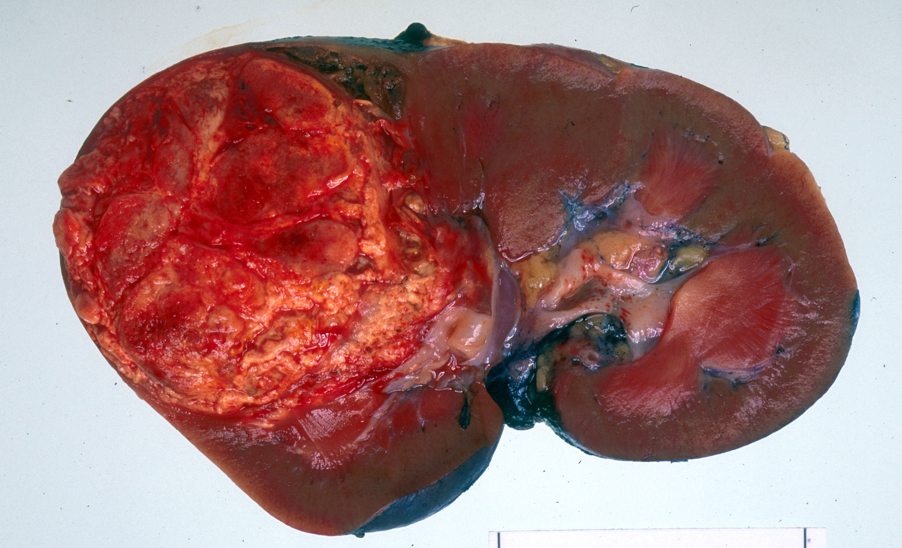 Kidney cancer