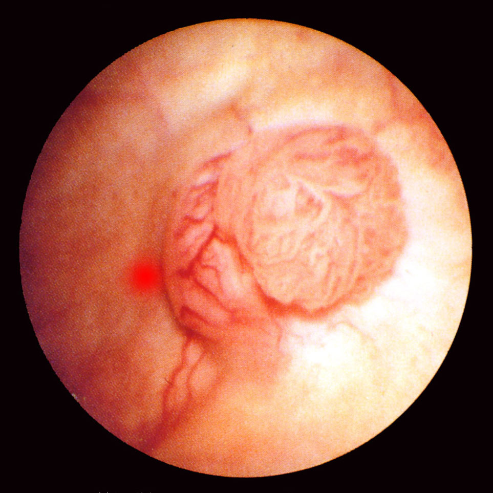 Bladder tumour