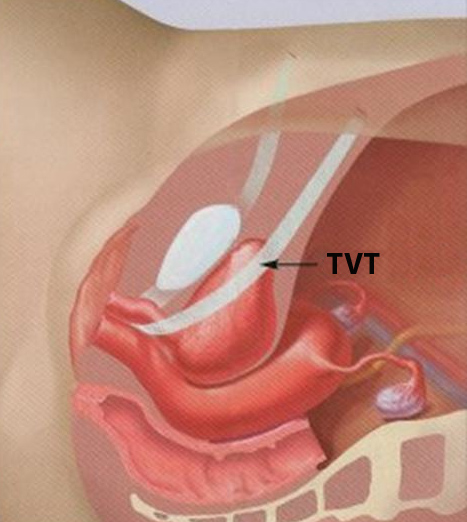 Vaginal tape (TVT)