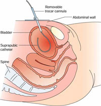 Suprapubic catheter