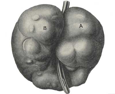 Prostate removed by Freyer