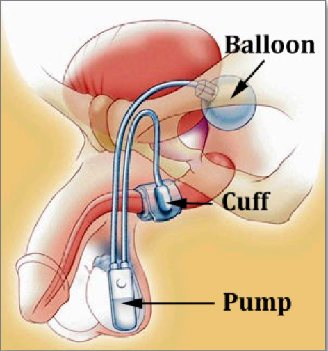 Artificial urinary sphincter in the male pelvis (balloon, cuff, pump)