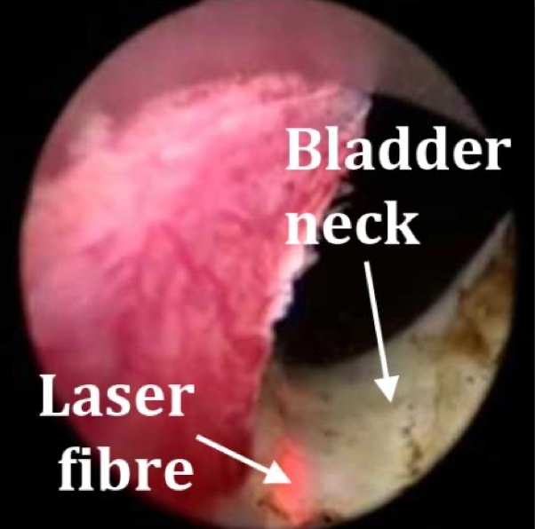 Bladder neck incision (BNI) — thick bladder neck