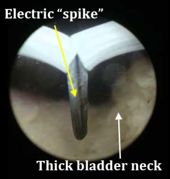 Bladder neck incision (BNI) — electric spike