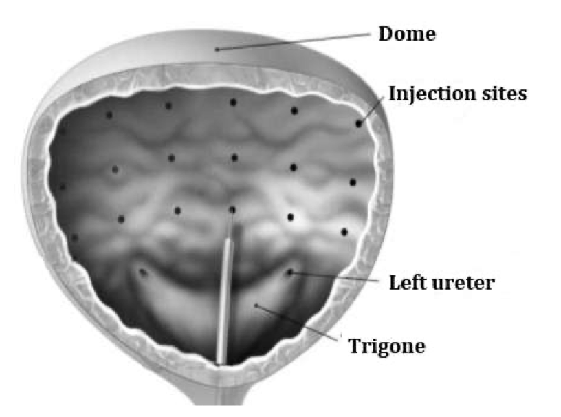Intravesical Botox injection sites
