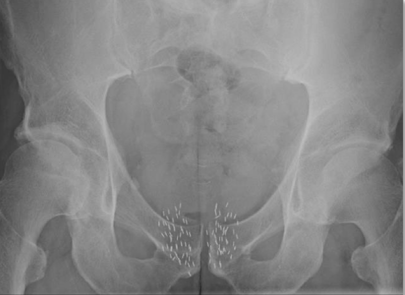 X-ray of brachytherapy seeds