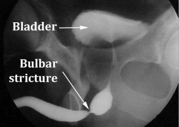 Bulbar urethral stricture on retrograde urethrogram