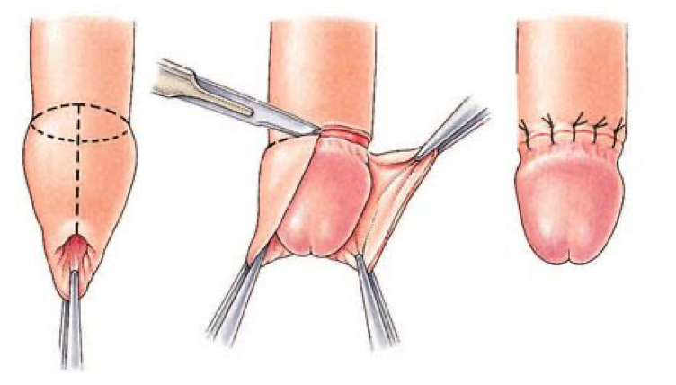 Circumcision — planned incisions and completed result