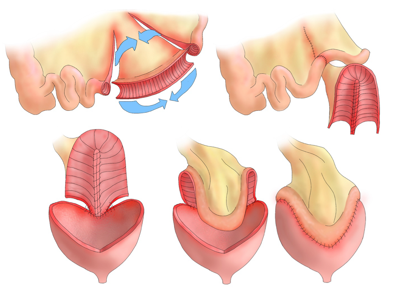 Augmentation cystoplasty (ileocystoplasty)