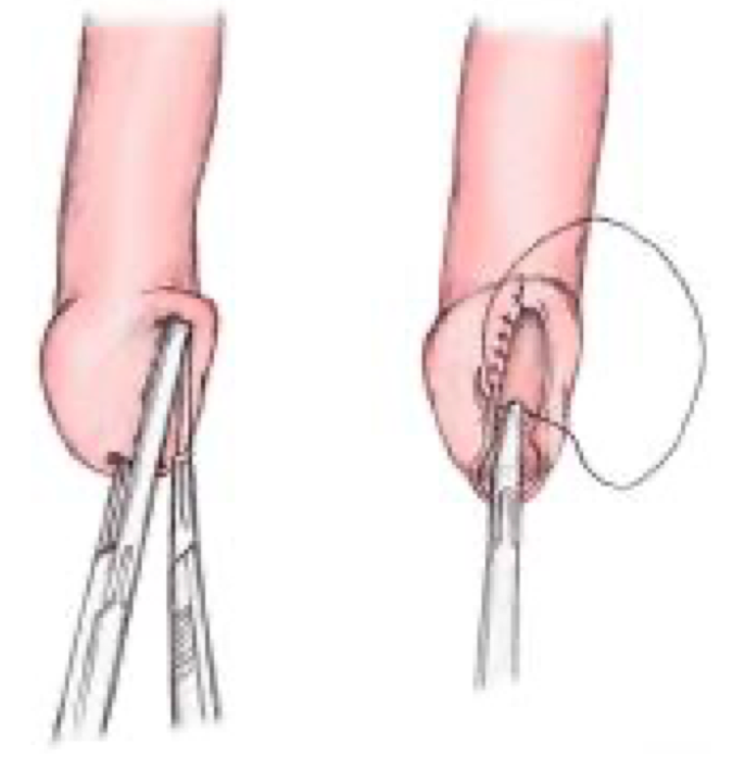 Dorsal slit — foreskin release and sutured repair