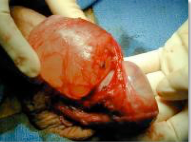 Large epididymal cyst attached to the testis at surgery