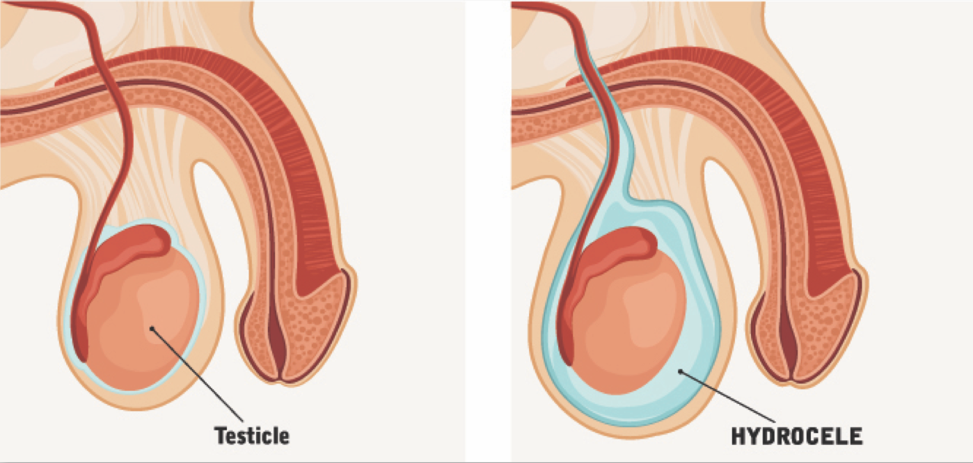 Normal testicle compared with hydrocele