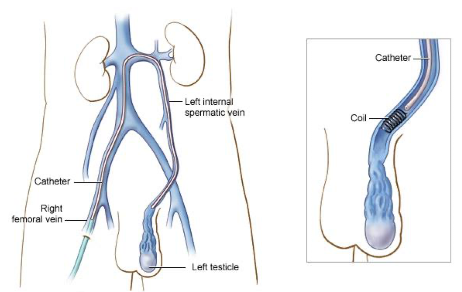 IR varicocele embolisation