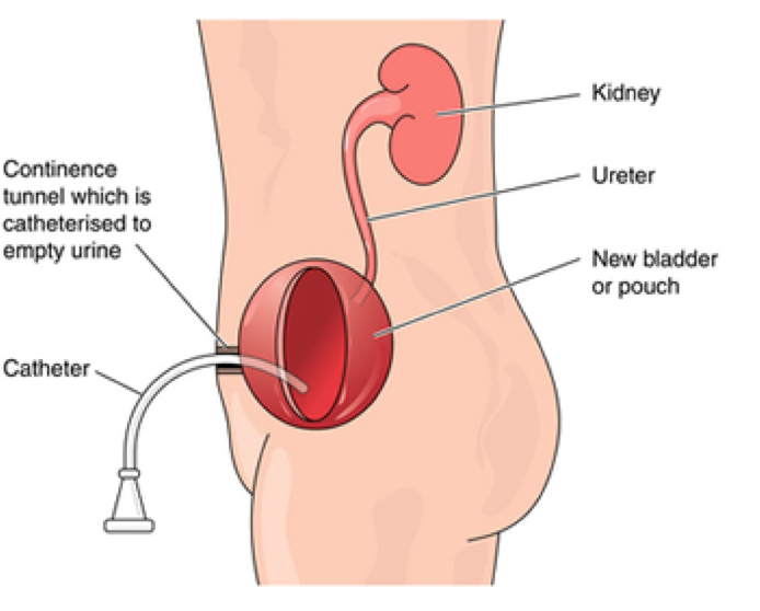 Continent cutaneous urinary diversion (Indiana / Mainz pouch)