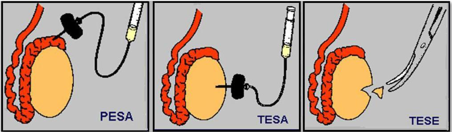 PESA, TESA and TESE sperm retrieval techniques