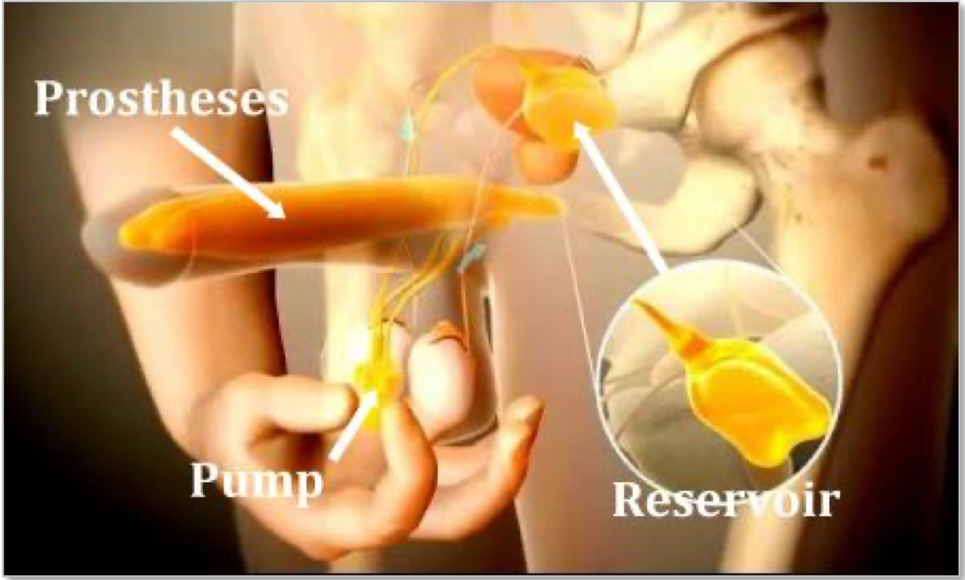 Three-piece inflatable penile prosthesis — cylinders, pump and reservoir