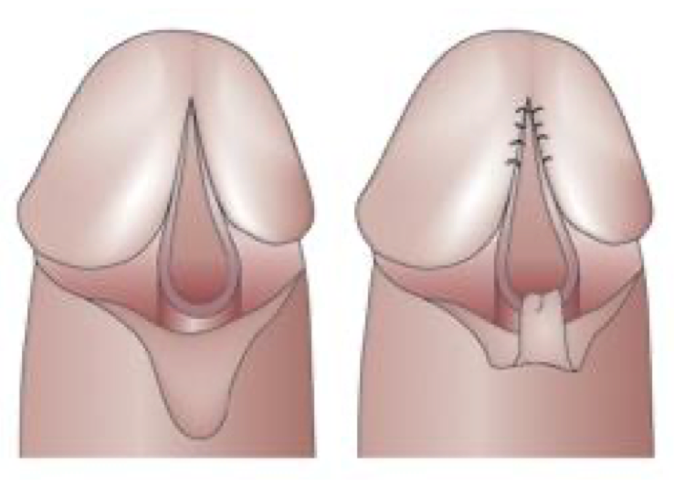 Meatoplasty before and after repair of elongated meatus