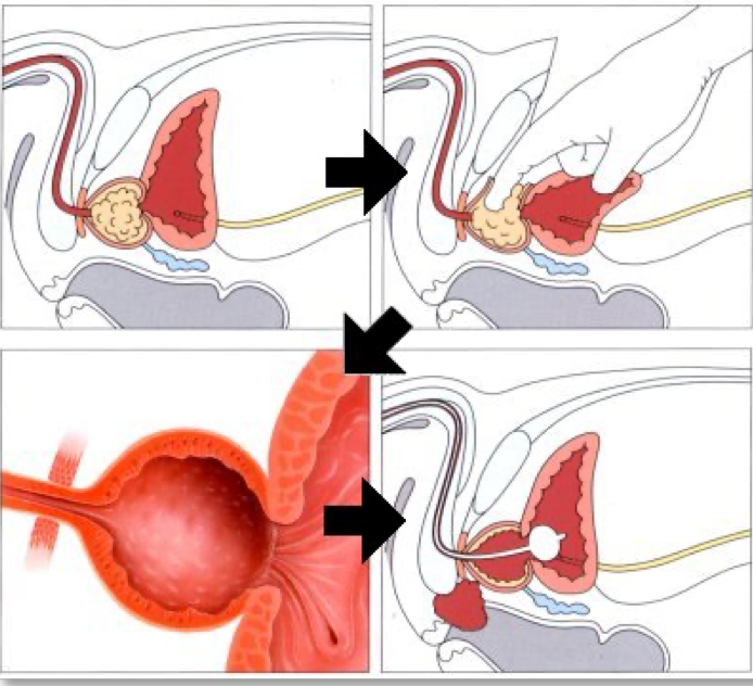 Millins prostatectomy for benign disease