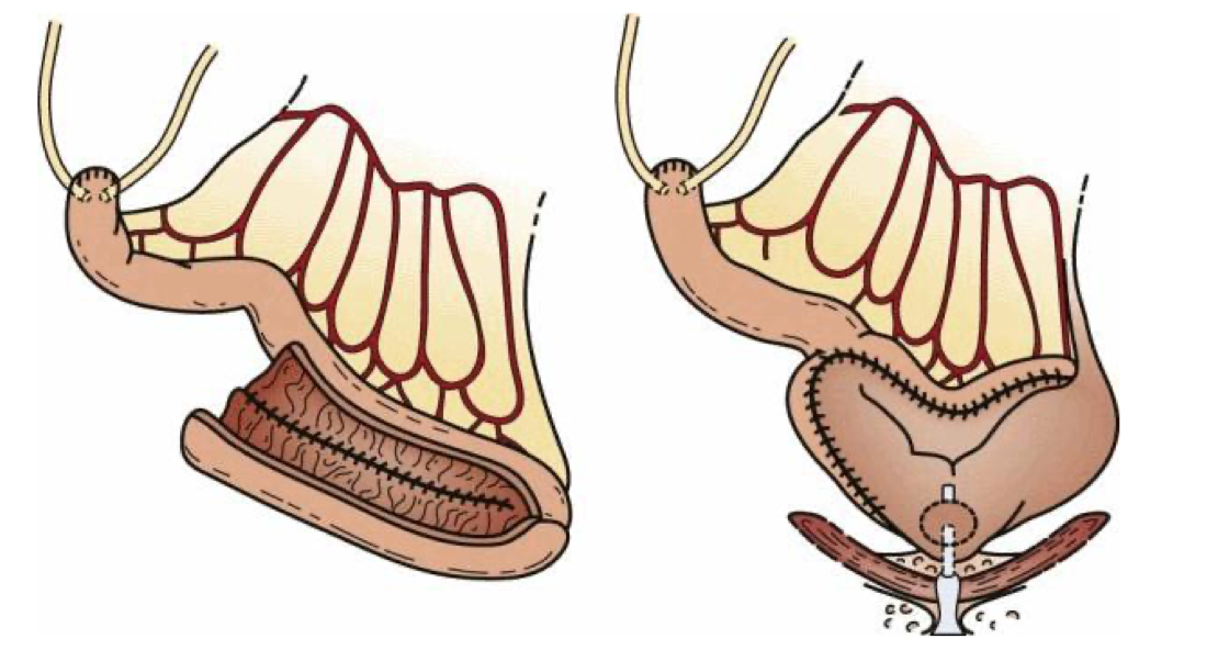 Orthotopic neobladder construction