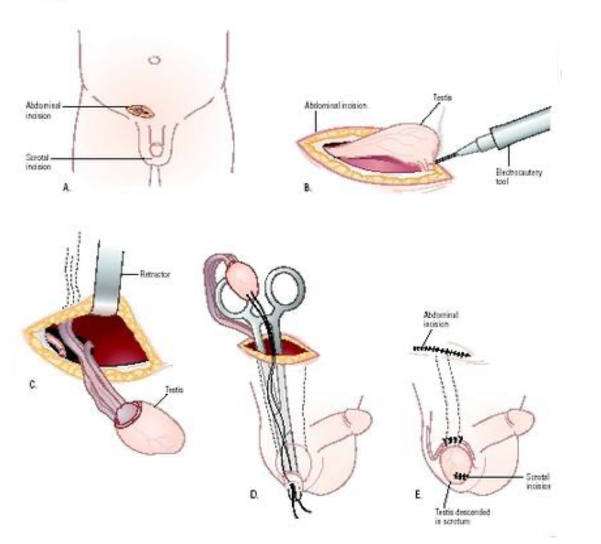 Orchidopexy — abdominal and scrotal incisions with testis fixation in scrotum