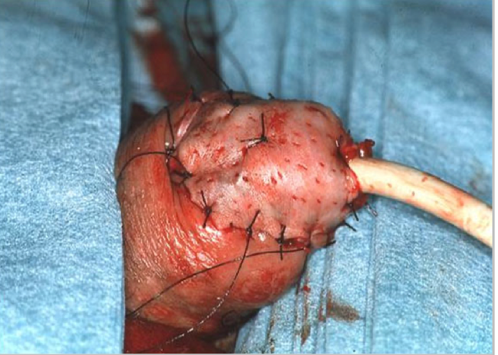 Split skin graft for glans reconstruction
