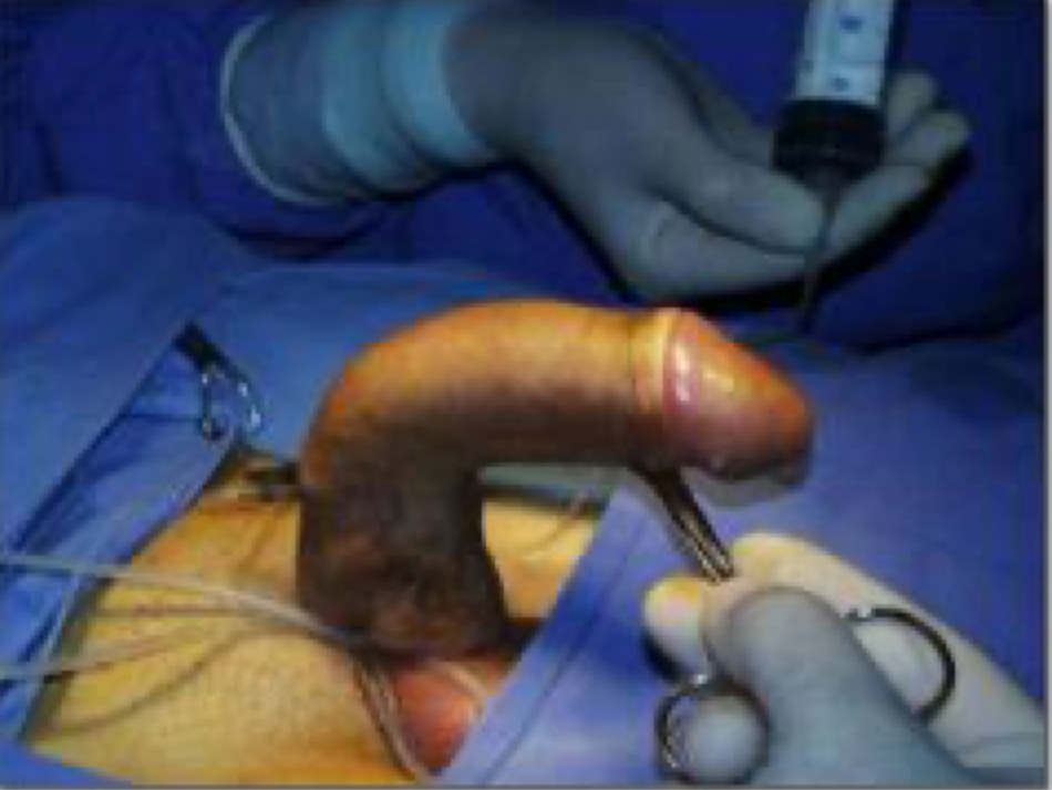 Penile curvature corrected during straightening surgery
