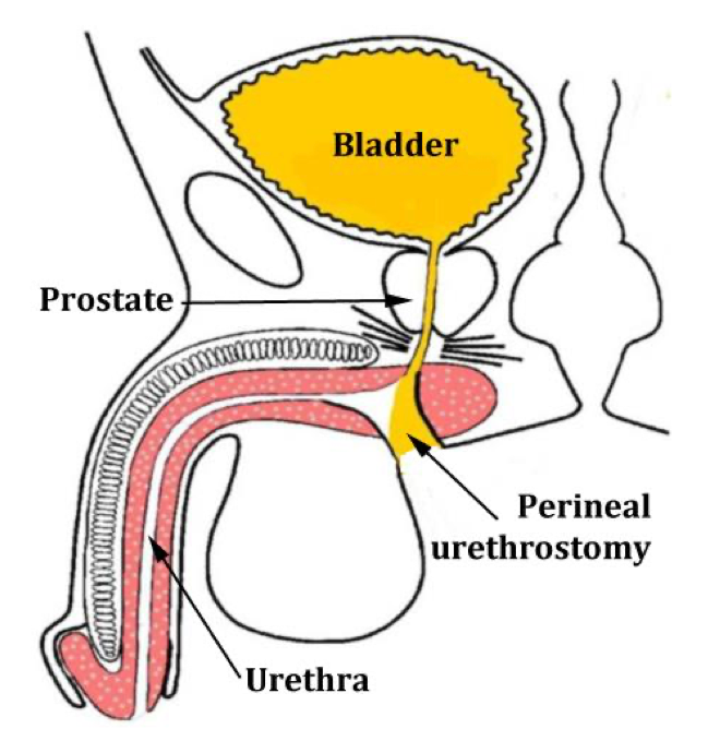 Perineal urethrostomy after total penectomy