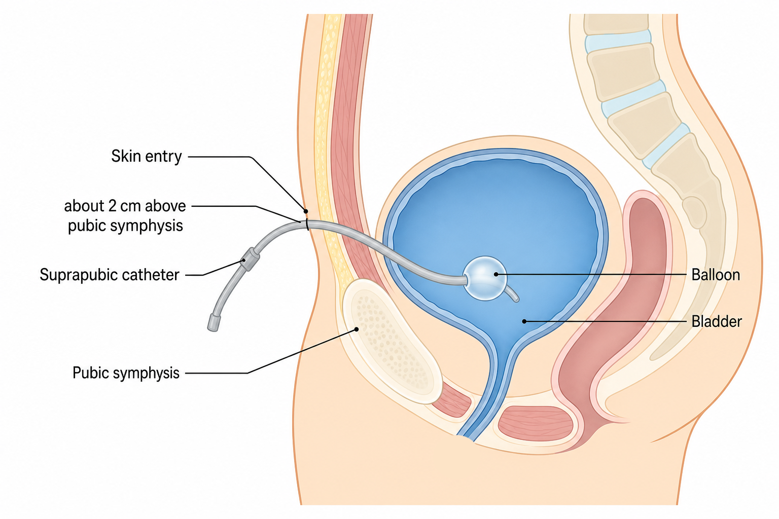 Suprapubic catheter placement — skin entry about 2 cm above the pubic symphysis, with balloon inflated in the bladder