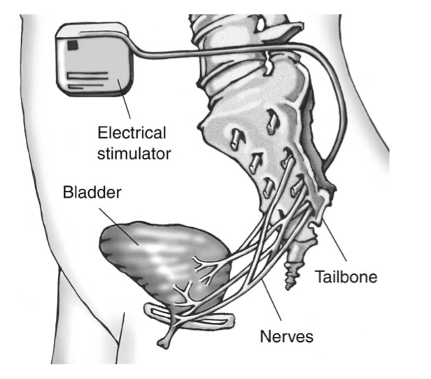 Sacral nerve stimulator placement