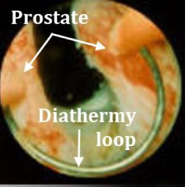 Transurethral resection of the prostate (TURP) — diathermy loop