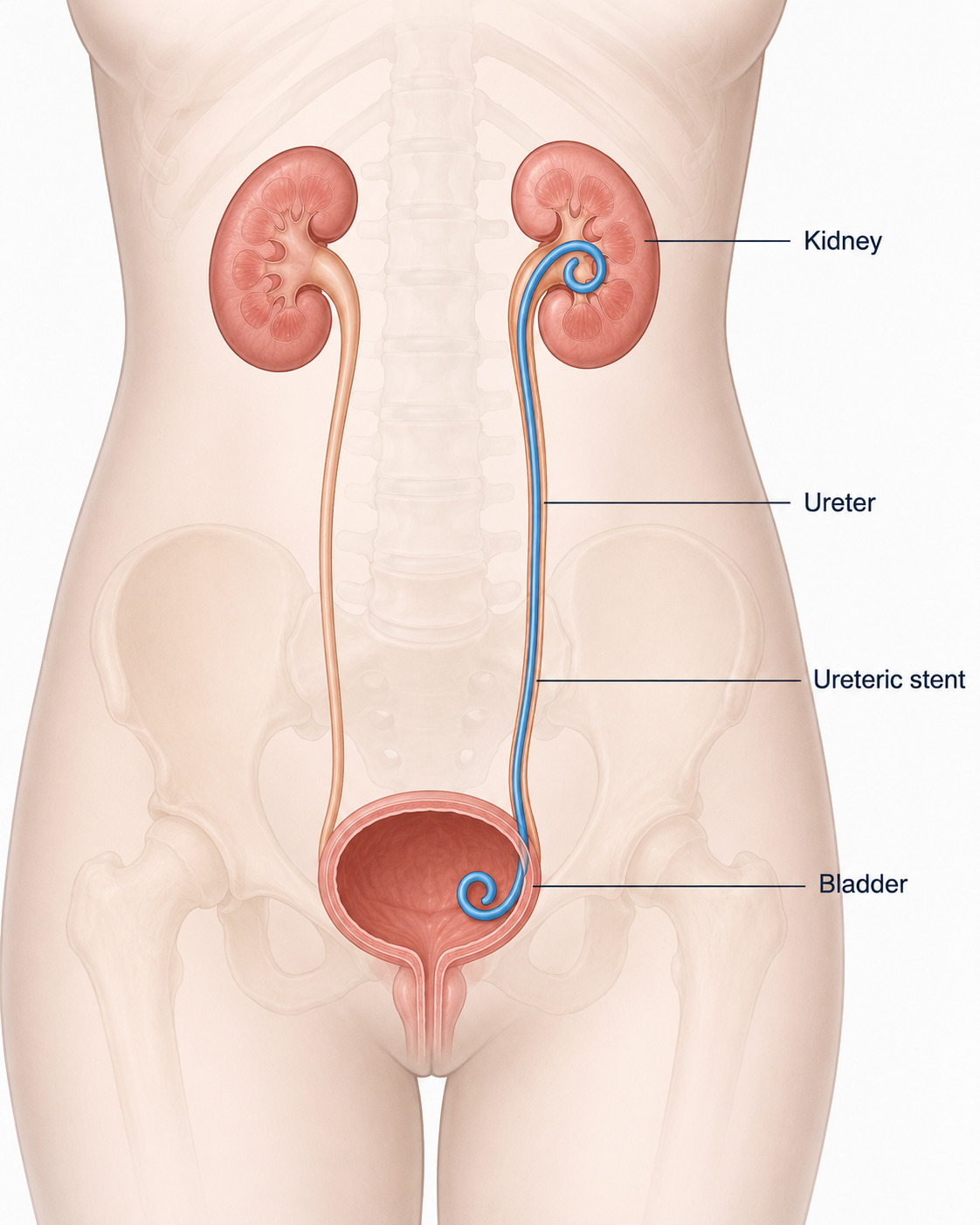 Ureteric stent
