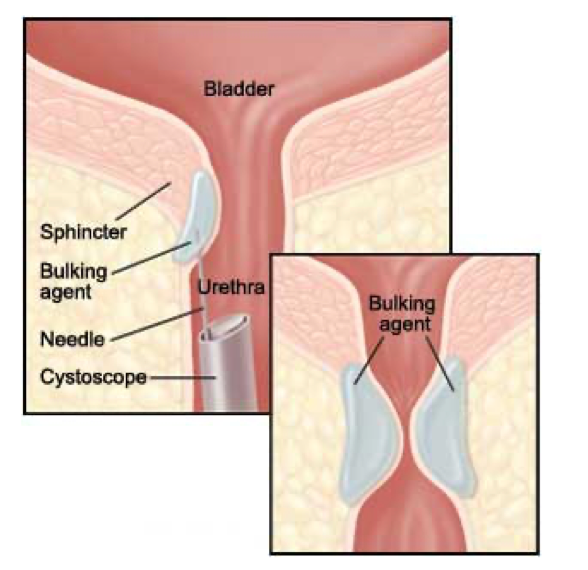 Urethral bulking agent injection